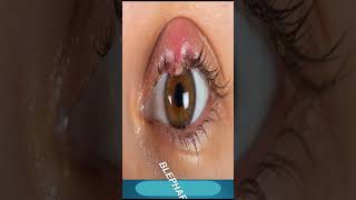 Blepharitis Treatment  Which Medicine Use In Blepharitis [upl. by Wat]