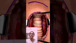 Tracheostomy SurgeryTracheotomy procedure [upl. by Nahs36]