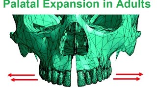 Is Palatal Expansion Possible In Adults By Dr Mike Mew [upl. by Ervine]