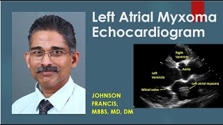 Left Atrial Myxoma Echocardiogram [upl. by Animlehliw]