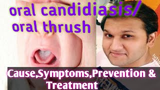 Oral Thrush Symptoms Causes Treatments Preventions  oral candidiasis [upl. by Wilhide]