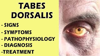 Tabes Dorsalis  Neurosyphilis Tabes Dorsalis  Tabes Dorsalis Signs amp Symptoms medicine [upl. by Eimar]