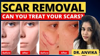 Get Your Scars Removed With This Secret Treatment  Laser Treatment Of Scar [upl. by Lud]