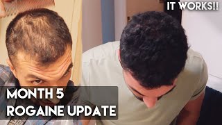 5 Month Rogaine Update Minoxidil  IT WORKS [upl. by Raquela]