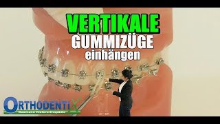 Gummizüge vertikal festsitzende Zahnspange Kieferorthopädie  Orthodentix [upl. by Natan]