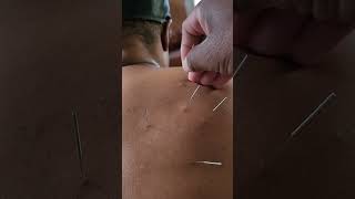 acupuncture needle needling upper back pain shortness of breath creating anxiety [upl. by Gschu]