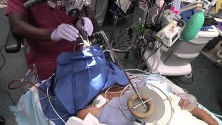 Vaporized tissue during laser airway surgery with jet ventilation [upl. by Willtrude]