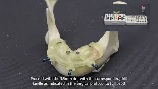 Straumann® Guided Surgery System and Straumann® BLT [upl. by Hallett26]