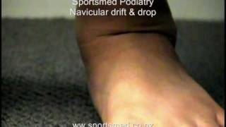 Sportsmed podiatry  Navicular drift and drop [upl. by Yrreiht]