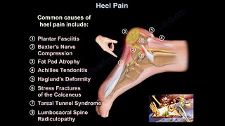 Heel Pain causes and treatment plantar fasciitis diagnosis and treatment [upl. by Basia387]