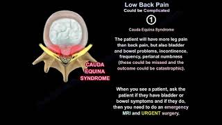 Understanding Complicated Low Back Pain Causes Symptoms and Treatment Options [upl. by Robma53]