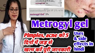 Metrogyl gel honest review  Metrogyl gel benefits uses amp side effects full review in hindi [upl. by Toomay]