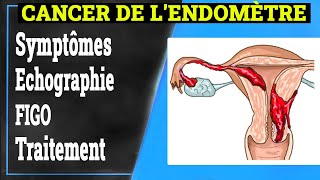 Cancer de lEndomètre Symptômes Causes Traitement  Gynécologie [upl. by Vaughan]