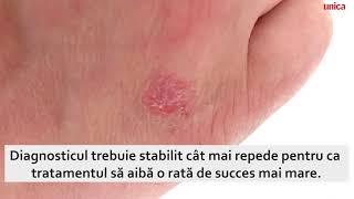 Artrita psoriazică Simptome și tratament [upl. by Renie638]