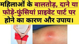 बालतोड़ या दाने  Boils in the private parts Area female  causes and Treatment for PimplesBoils [upl. by Christina]