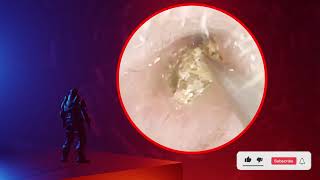 The Truth About earwax Will Shock You How to remove earwax from ear earwax extractions [upl. by Hegarty]