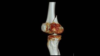 Femur medial condyle fracture [upl. by Queston346]