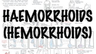 Haemorrhoids Hemorrhoids  Overview pathophysiology investigations and treatment [upl. by Nalat]