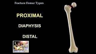 Fracture Femur Types  Everything You Need To Know  Dr Nabil Ebraheim [upl. by Tzong403]