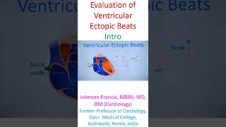 Evaluation of Ventricular Ectopic Beats [upl. by Erleena]