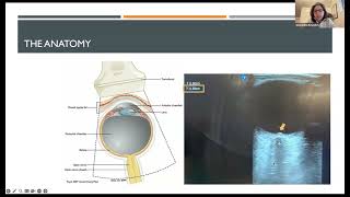 Neurocritical Care amp Pearls Noninvasive Monitoring of Intracranial Pressure Alexandra Reynolds MD [upl. by Atinele]