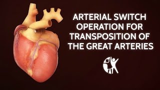 Arterial Switch Operation for Transposition of the Great Arteries  Cincinnati Childrens [upl. by Irah]