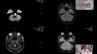 Caso Clínico Micro angiopatia Cerebral Infartos Lacunares Multiples Dr Jorge Ivan Ospina [upl. by Ecyrb]