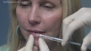 Lip Augmentation with Juvederm Injection  Fort Lauderdale [upl. by Rugg996]