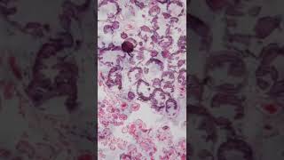 Psammoma Bodies  Pathology shorts [upl. by Eolcin]