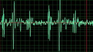 Congestive Heart Failure slow [upl. by Egedan]