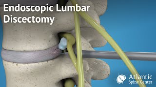 Endoscopic Lumbar Discectomy [upl. by Hagan]