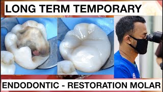 Dental Endodontic Direct Restoration Long Term Temporary Composite  General Dentist Griya RR [upl. by Attelrahc]