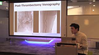 Angiojet case based review part 1 세브란스병원 한기창 교수님 [upl. by Diao416]