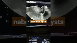 Nabothian cyst seen in the cervix ultrasound [upl. by Nnanerak]