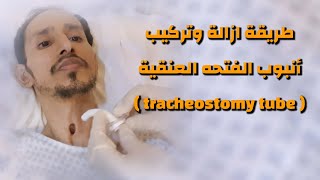 طريقة تركيب انبوب الفتحه العنقية  how to change the tracheostomy tube [upl. by Chari]