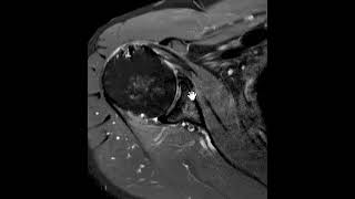 Subcoracoid impingment and subscapularis tendon tear [upl. by Seugirdor857]