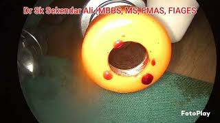 Acute Appendicitis Laparoscopic Appendicectomy Best approach16yrs Girl Pain abdomen Dr Sekendar [upl. by Ailito]