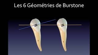 Biomécanique Orthodontique N°2  Géométries de Burstone [upl. by Aloisius]