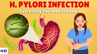 Helicobacter Pylori Infection – Causes Signs and Symptoms Diagnosis amp Treatment [upl. by Ainoek]