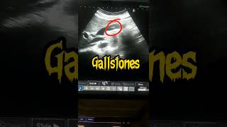 Gallbladder Stones gallstones ultrasound [upl. by Bradski]