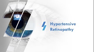 Retina 5  Hypertensive Retinopathy [upl. by Verene]