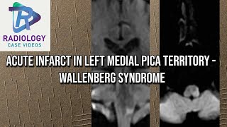 Acute infarct in left Medial PICA territory  Wallenberg syndrome [upl. by Smada]