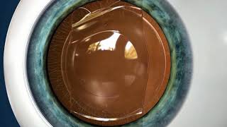 Vision Correction for High Levels of Myopia amp Astigmatism [upl. by Haduhey]