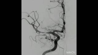 MCA Thrombectomy [upl. by Ecela147]