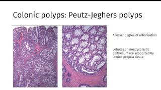 GI polyps GIPATH [upl. by Aleekahs]