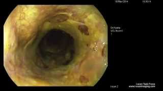 Early squamous neoplasia of the oesophagus sq emr [upl. by Birk]