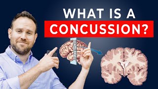 What is a Concussion  Concussion Patient Education Series  Ep 1 [upl. by Ellehcir]