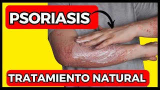 ✅👉 PSORIASIS 👉CAUSAS SÍNTOMAS Y TRATAMIENTO  Descubre cómo combatir la psoriasis de forma efectiva [upl. by Herrle]