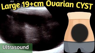 Ultrasound 19 cm Large Ovarian Cyst  equal to size of Handball in Abdomen [upl. by Lirbaj879]