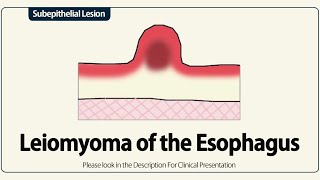 Leiomyoma of the Esophagus [upl. by Magdalena]